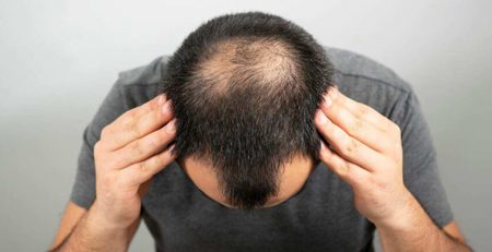 Hair Transplant in Delhi