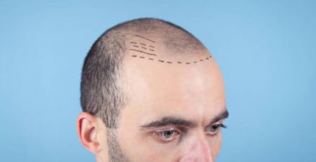 Hair Transplant in Delhi