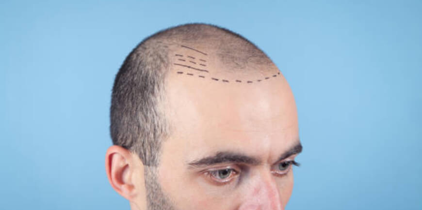 Hair Transplant in Delhi