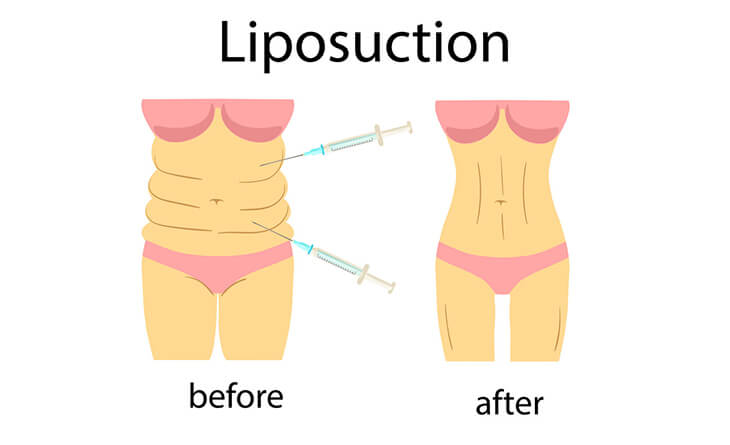 Does Liposuction Remove Fat Permanently - Dr Lokesh Handa - Best Plastic Surgeon in Delhi 02