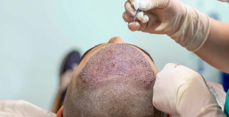 What is the Success Rate of Hair Transplants - Dr Lokesh Handa - Best Plastic Surgeon in Delhi 01