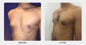 Asymmetric Gynecomastia Grade 2A-1 before after - Dr Lokesh Handa - Best plastic surgeon in delhi -03