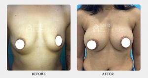 breast augmentation- Result- Dr Lokesh Handa -022
