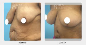 Breast Lift before after - Dr Lokesh Handa - Best plastic surgeon in delhi -01