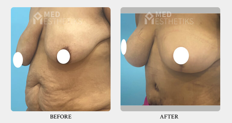 Breast Lift before after - Dr Lokesh Handa - Best plastic surgeon in delhi -01
