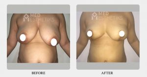 Breast Lift before after - Dr Lokesh Handa - Best plastic surgeon in delhi -01