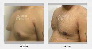 Gynecomastia Grade 2A-B before after - Dr Lokesh Handa - Best plastic surgeon in delhi -03