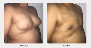 Gynecomastia Grade 2B before after - Dr Lokesh Handa - Best plastic surgeon in delhi -03