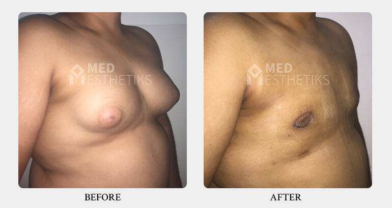 Gynecomastia Grade 2B before after - Dr Lokesh Handa - Best plastic surgeon in delhi -03