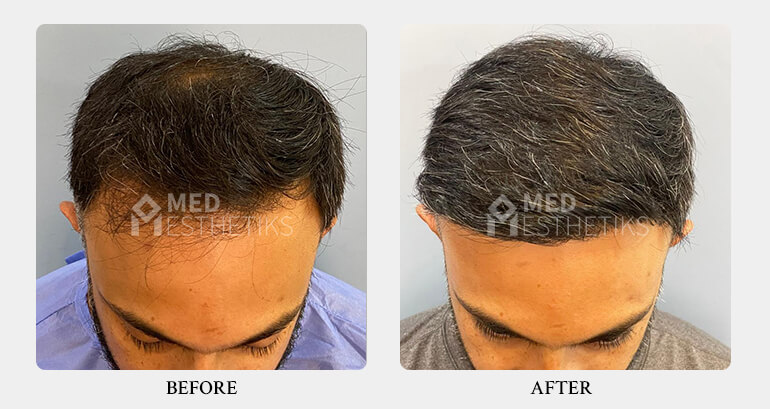 Hair Transplant before after - Dr Lokesh Handa - Best plastic surgeon in delhi -03