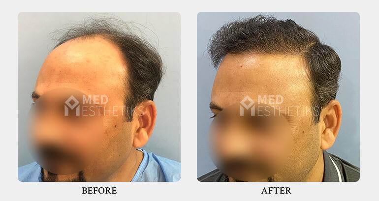 Hair Transplant before after - Dr Lokesh Handa - Best plastic surgeon in delhi -03