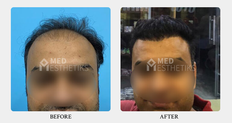 Hair Transplant before after - Dr Lokesh Handa - Best plastic surgeon in delhi -03