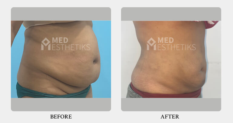 Liposuction Surgery before after - Dr Lokesh Handa - Best plastic surgeon in delhi -04