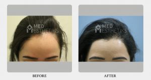 hairline before after - Dr Lokesh Handa - Best plastic surgeon in delhi -05