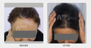 hairline before after - Dr Lokesh Handa - Best plastic surgeon in delhi -05