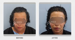 hairline before after - Dr Lokesh Handa - Best plastic surgeon in delhi -05