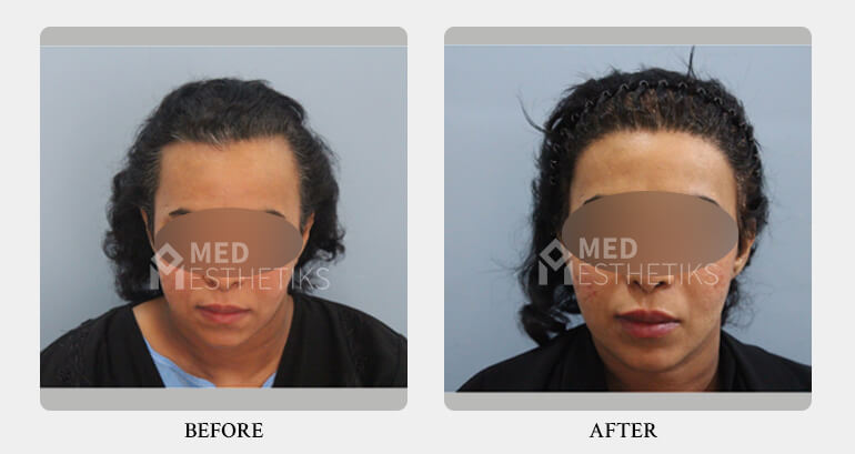 hairline before after - Dr Lokesh Handa - Best plastic surgeon in delhi -05