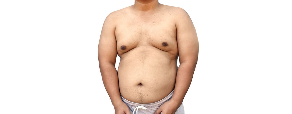 Can Gynecomastia Be Treated With Liposuction - Dr Lokesh Handa - Best Plastic Surgeon in Delhi -01