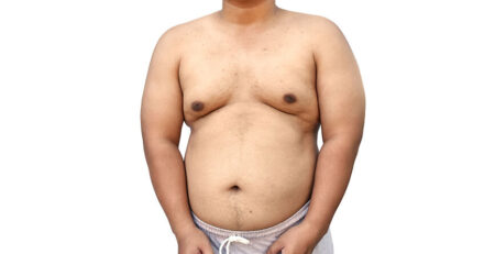 Can Gynecomastia Be Treated With Liposuction - Dr Lokesh Handa - Best Plastic Surgeon in Delhi -01