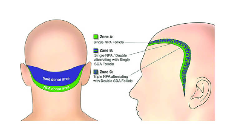 Hair Transplant with Less Donor Area