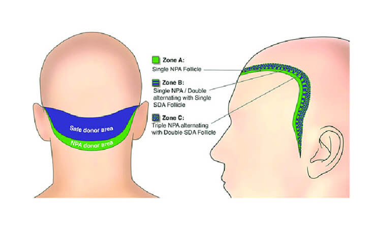 Hair Transplant in delhi