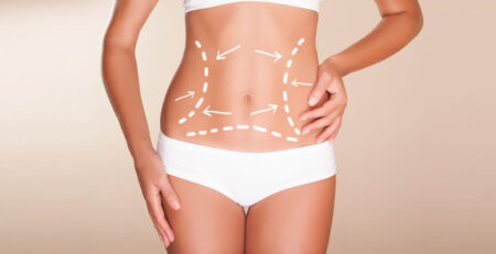 Liposuction Surgery in Delhi