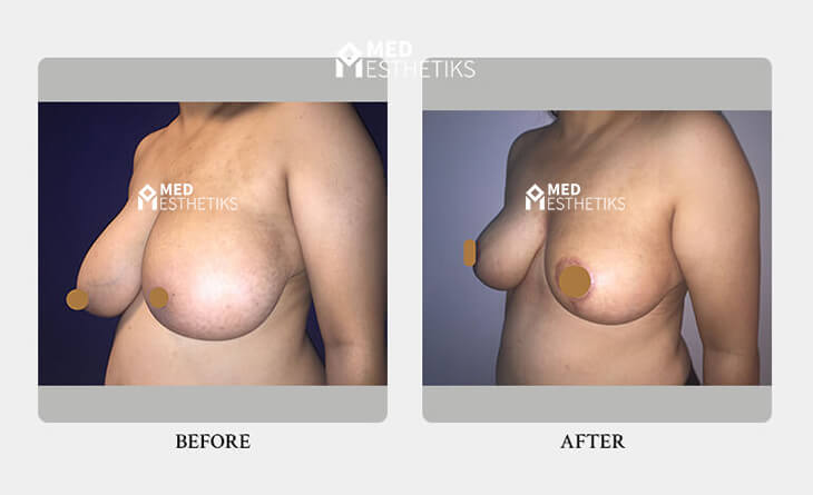 Breast Reduction Surgery Before After Results - Dr Lokesh Handa - Med Esthetiks