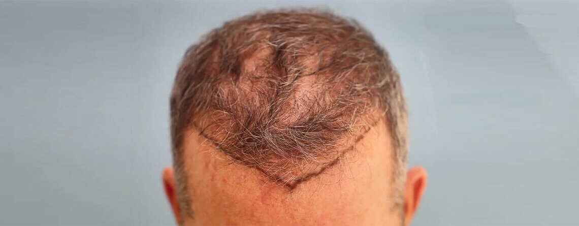 Hair transplant in Delhi