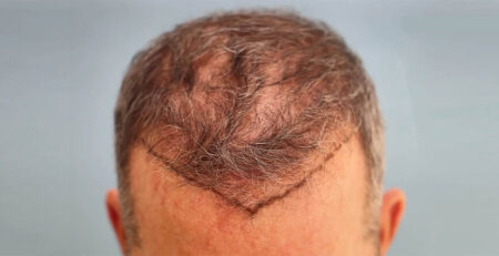 Hair transplant in Delhi