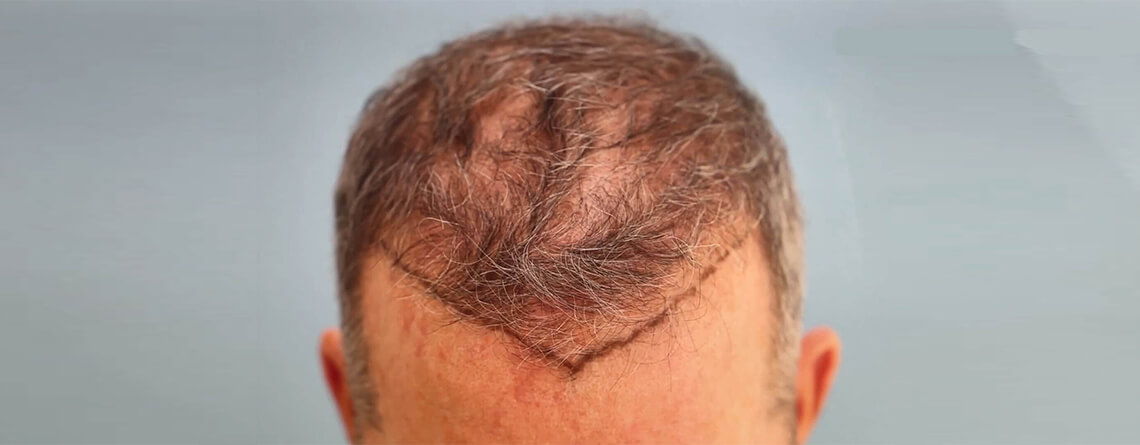 What are the Different Types of FUE Hair Transplants?