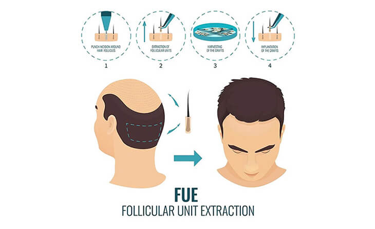 What are the Different Types of FUE Hair Transplants? What are the Different Types of FUE Hair Transplants?