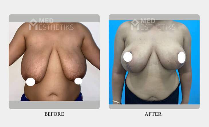 Breast Lift surgery in Delhi