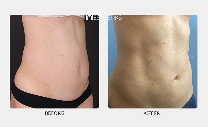 Liposuction surgery in Delhi