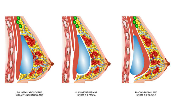 Breast Augmentation Surgery