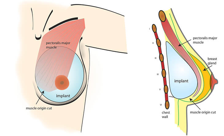 Breast Augmentation Surgery