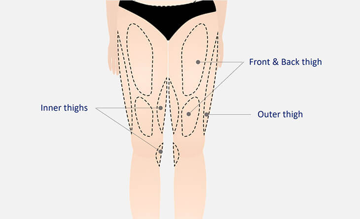 How Long Does Inner Thigh Lipo Last? - Ideal Face & Body