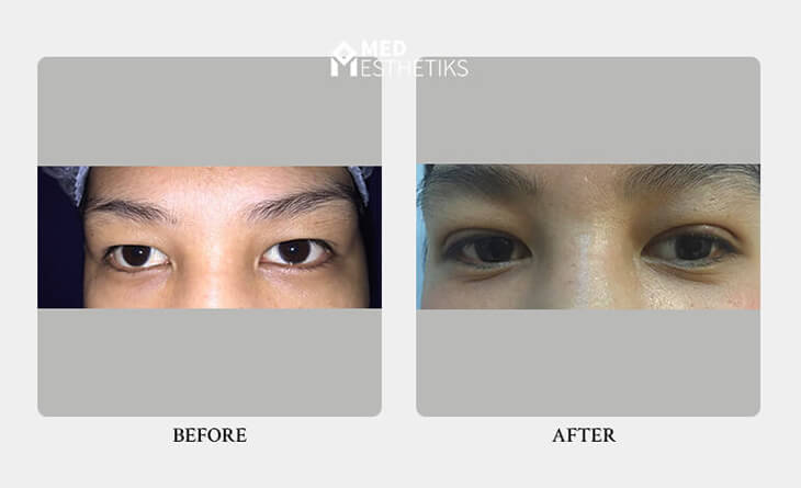 Eyelid surgery