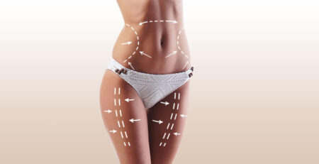 Liposuction Surgery in Delhi