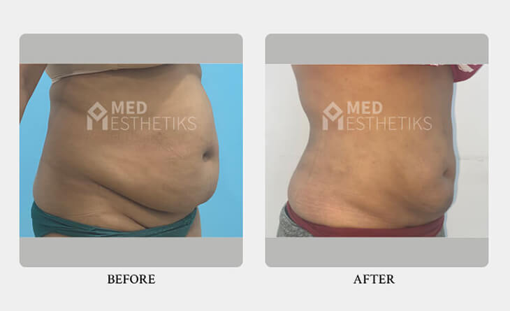 Liposuction Surgery Before After Result