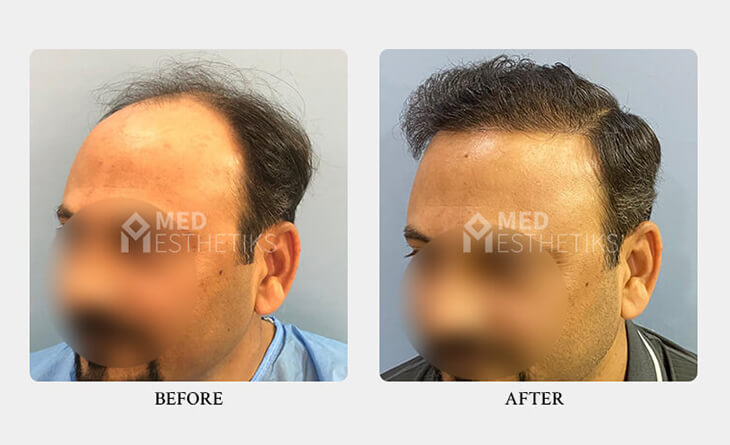 Hair Transplant Surgery Before After