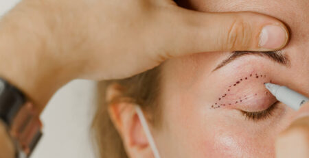 Blepharoplasty surgery in Delhi