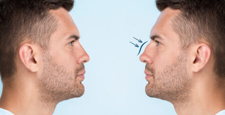 Rhinoplasty surgery in Delhi