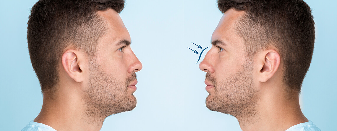 Rhinoplasty surgery in Delhi