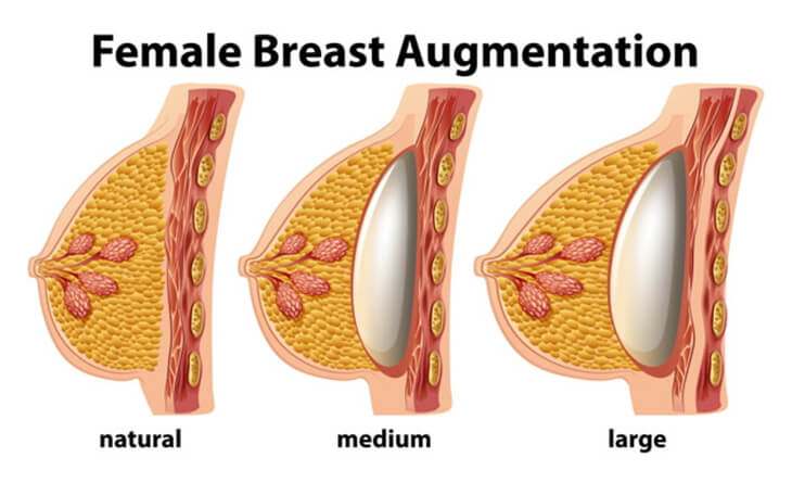 Breast Augmentation Surgery