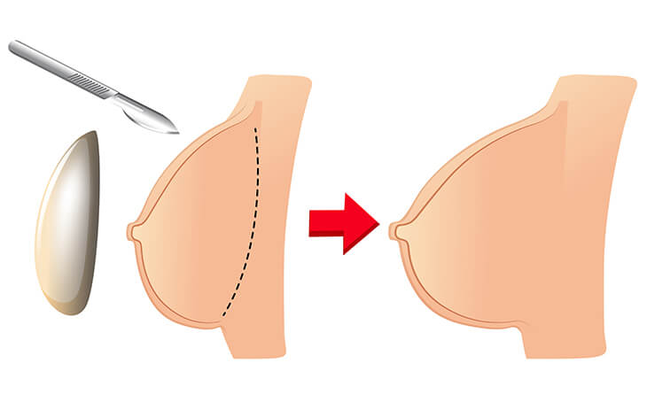 Breast Augmentation Surgery in Delhi