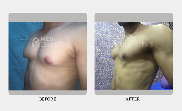 Gynecomastia Grade 1-2A before after