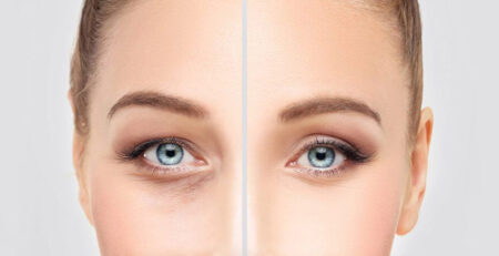 blepharoplasty surgery procedure