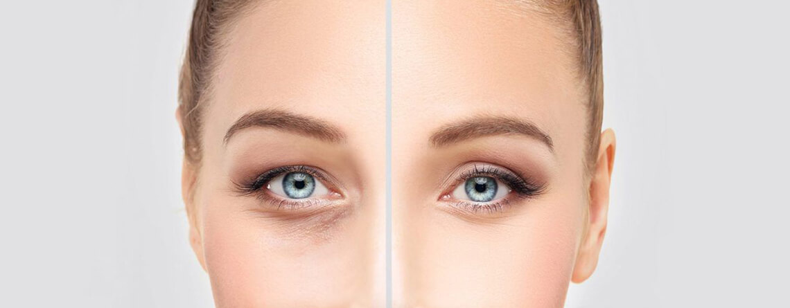 blepharoplasty surgery procedure