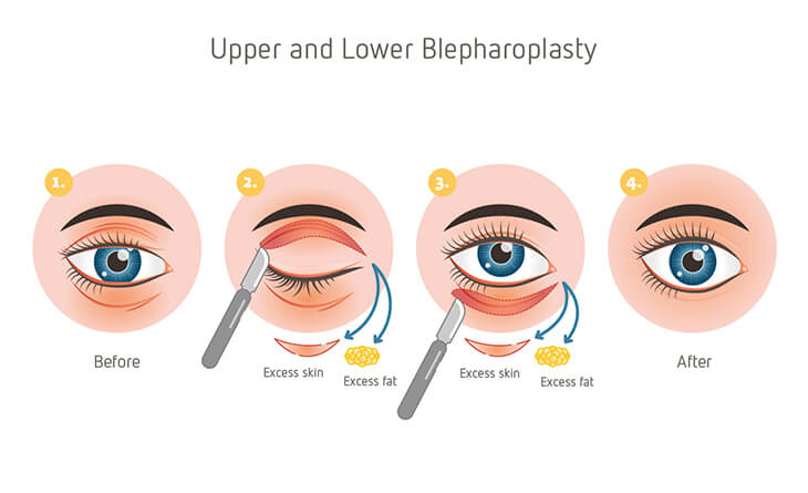 blepharoplasty surgery procedure