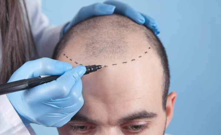 Hair Transplant in Delhi